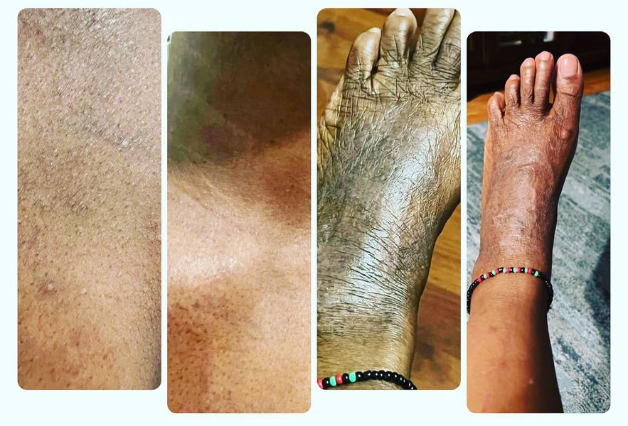 Pollen and Skin Allergies